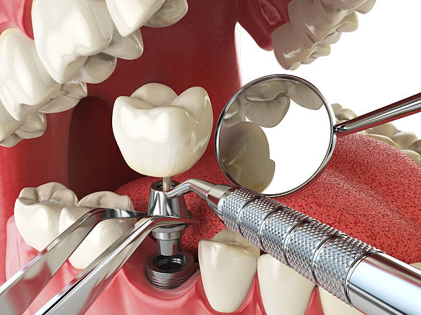 Best Emergency Dentist for Lost Fillings or Crowns in Nashville, IN